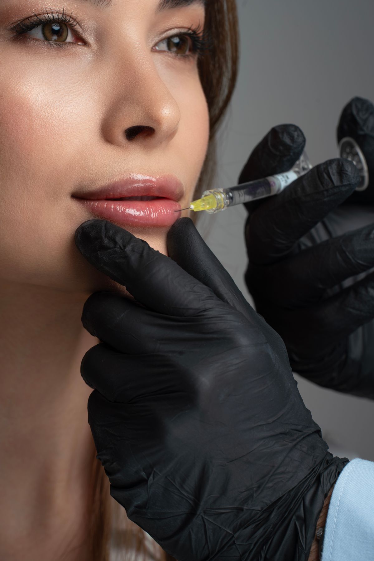Lip Augmentation treatment